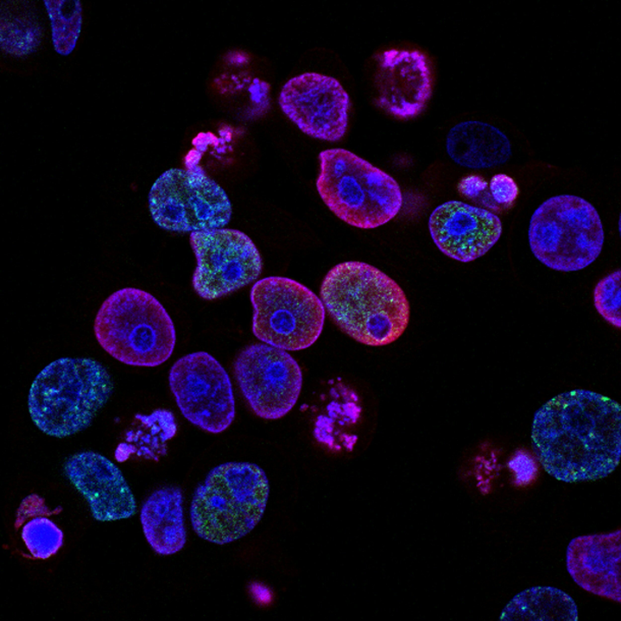 Kranus Lutera: Prostate cancer